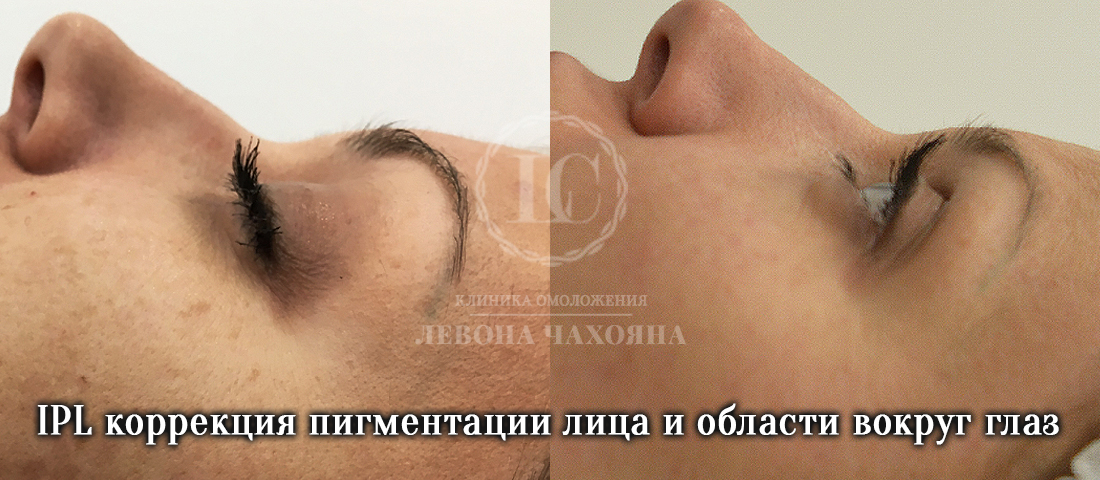 Как убрать темные круги под глазами быстро, причины появления синяков под глазами