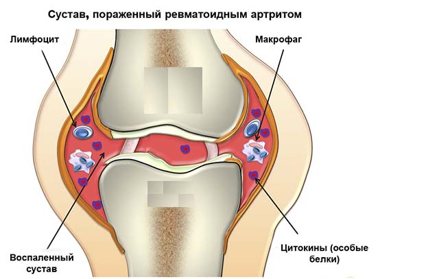 Ревматоидный артрит