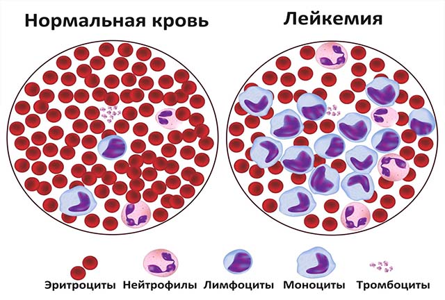 Лейкемия