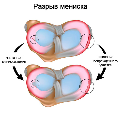 разрыв мениска