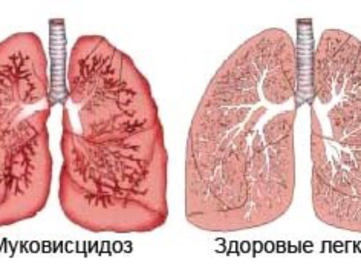 Муковисцидоз