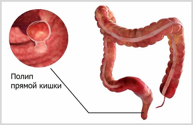 Что делать, если опух задний проход