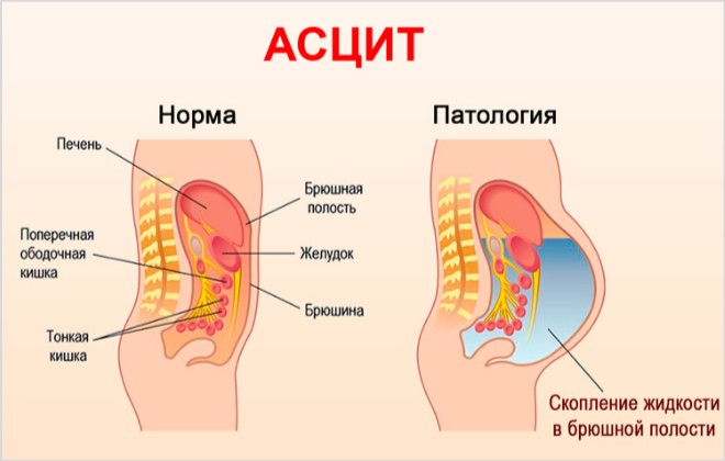 Жидкость в брюшной полости (отек живота): причины, лечение
