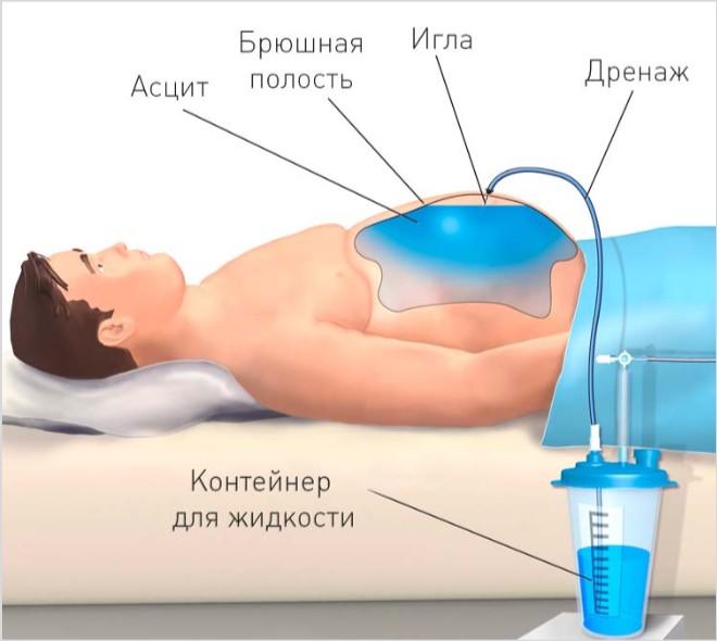 Жидкость в брюшной полости (отек живота): причины, лечение