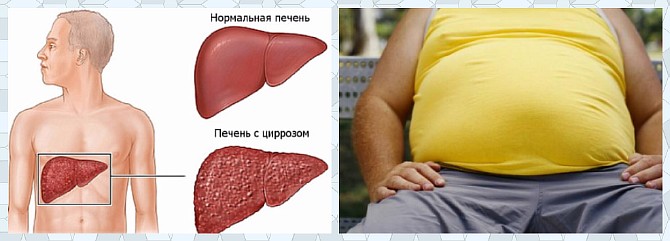 Увеличение живота при циррозе