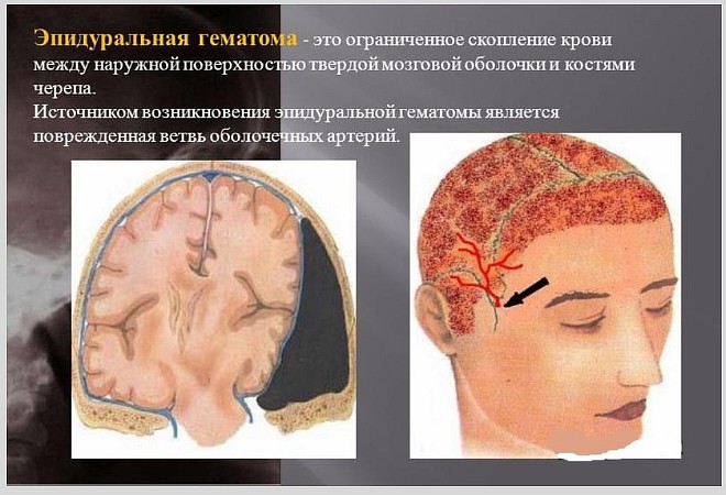 Чем опасны эпидуральные гематомы