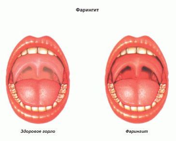 Как выглядит фарингит Изображение 1: Фарингит - клиника Семейный доктор