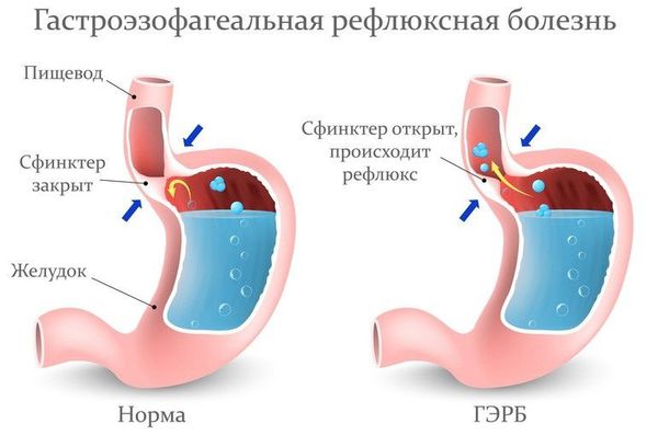 Гастроэзофагеальная рефлюксная болезнь Гастроэзофагеальная рефлюксная болезнь