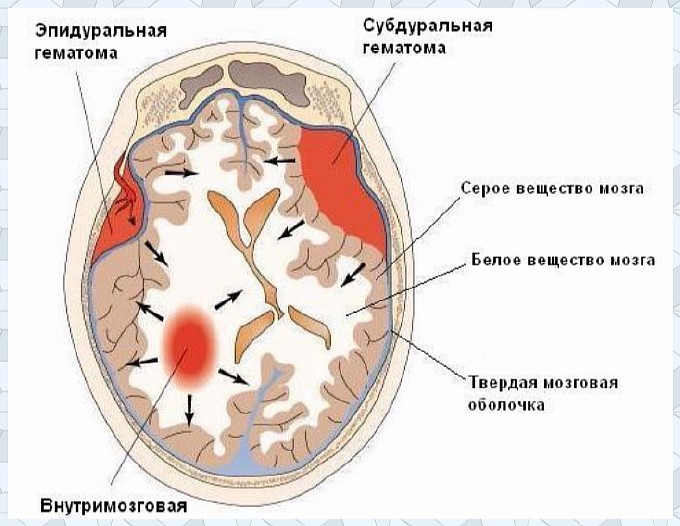Чем опасна гематома (шишка) на голове новорожденного