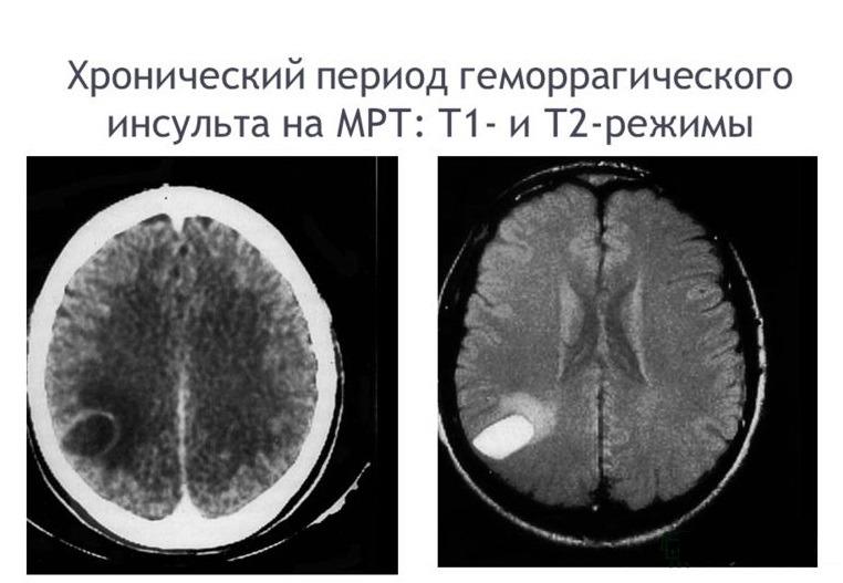 Симптомы, диагностика, лечение хронической субдуральной гематомы головного мозга, операция и реабилитация в Бурденко в Москве