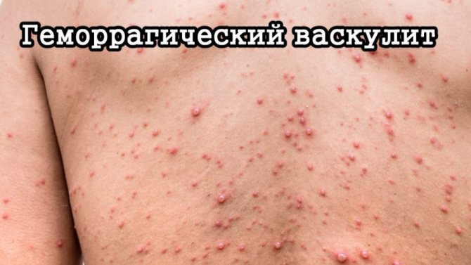 Не проходит синяк: почему долго на теле, может ли быть симптом заболевания, если на ноге, руке, теле, что делать