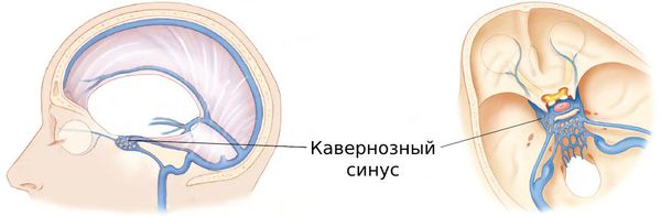 Кавернозный (пещеристый) синус Кавернозный (пещеристый) синус