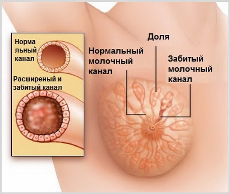 Как расцедить застой молока у женщины