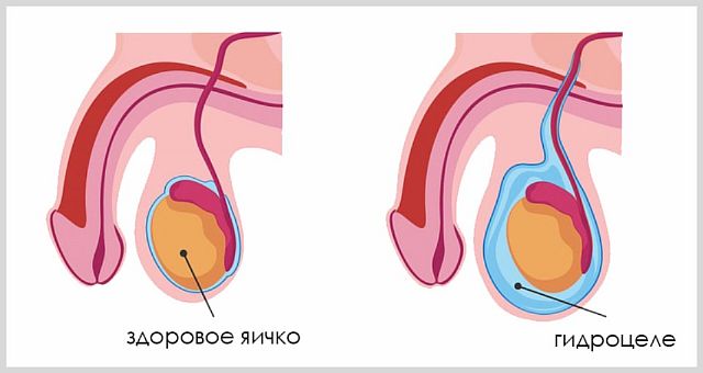 Что делать, если болит и опухло левое яичко
