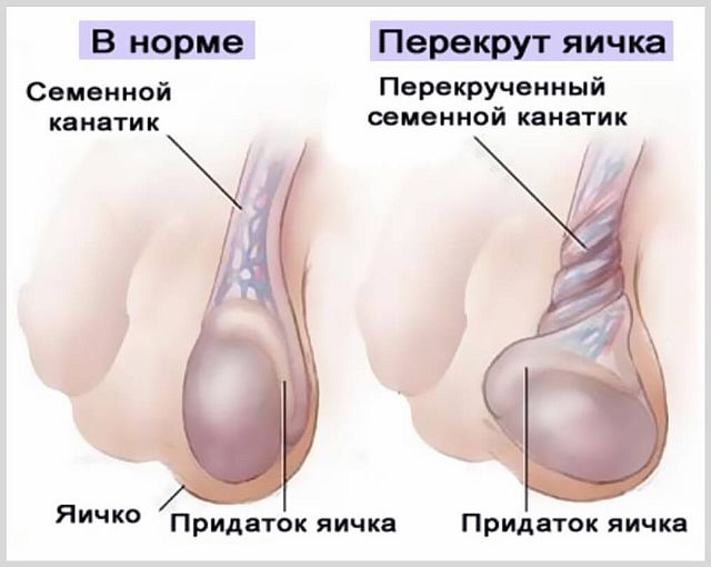 Что делать, если болит и опухло левое яичко