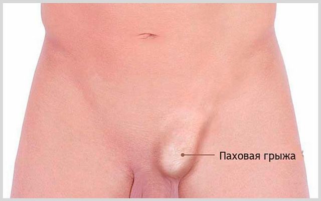 Что делать, если болит и опухло левое яичко