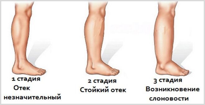 Опух лимфоузел - что делать и как лечить