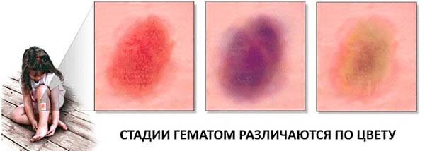 Лопаются кровеносные сосуды и капилляры на ногах, появляются синяки: причины и лечение