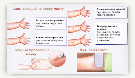 na-kakoy-den-proveryayut-mantu-u-rebenka-04.jpg na-kakoy-den-proveryayut-mantu-u-rebenka-04.jpg
