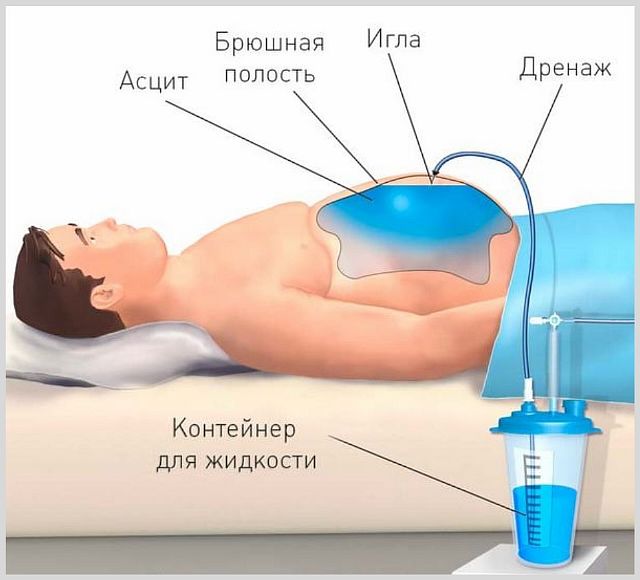 Злокачественный отек - что делать