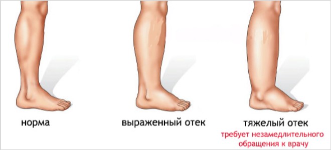 Из-за чего возникает отек ног у диабетиков