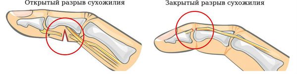 Открытые и закрытые разрывы сухожилий Открытые и закрытые разрывы сухожилий