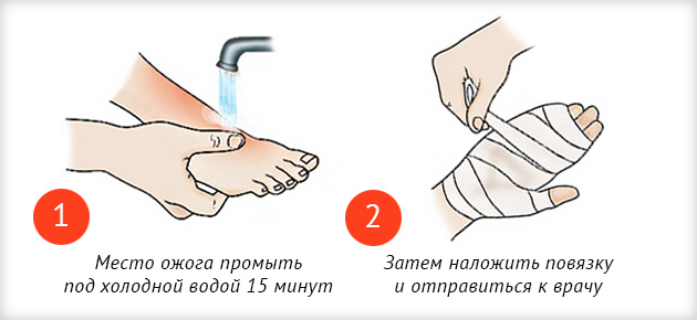 первая помощь при ожогах
