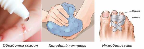 помощь при ушибе пальца на ноге