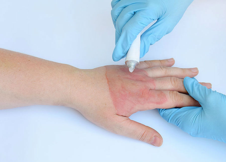 Пурпура Геноха-Шенлейна - ревматоидная пурпура, иммунная комплексная пурпура Противозудная мазь