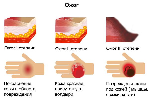 Степени ожоговой травмы Степени ожоговой травмы