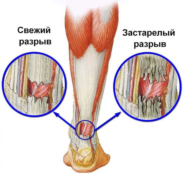 Свежий и застарелый разрывы сухожилий Свежий и застарелый разрывы сухожилий