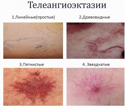 Не проходит синяк: почему долго на теле, может ли быть симптом заболевания, если на ноге, руке, теле, что делать