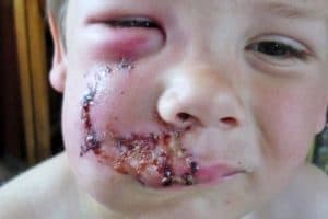 Укус собаки в область головы