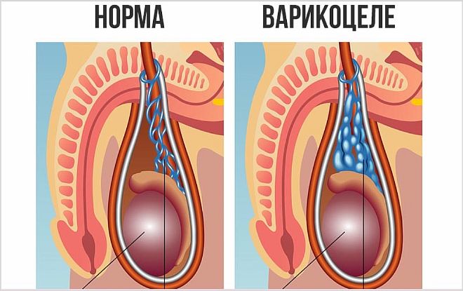 Варикоз вен на левом яичке: симптомы, методы лечения