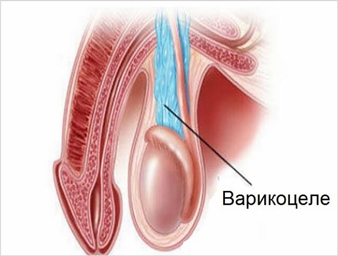 Расширенные вены на яичке у подростков