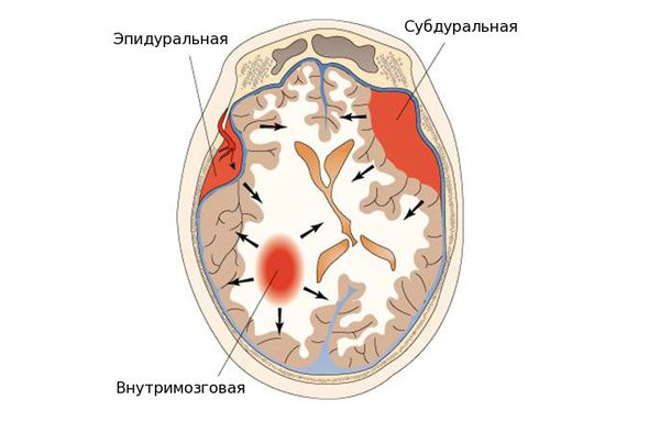 Виды гематом Виды гематом