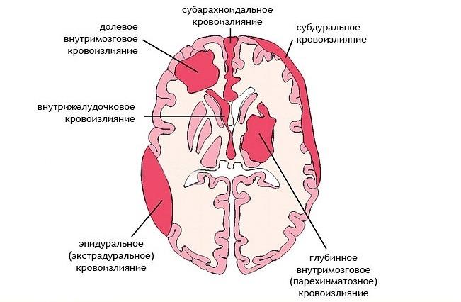Симптомы, диагностика, лечение хронической субдуральной гематомы головного мозга, операция и реабилитация в Бурденко в Москве