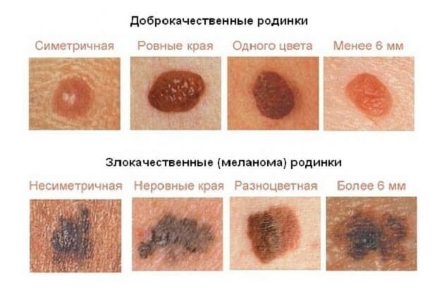 Виды родинок на коже