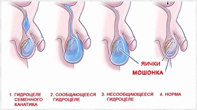 Водянка яичка